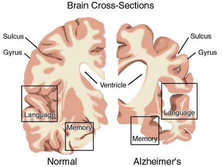 alzheimer_brain