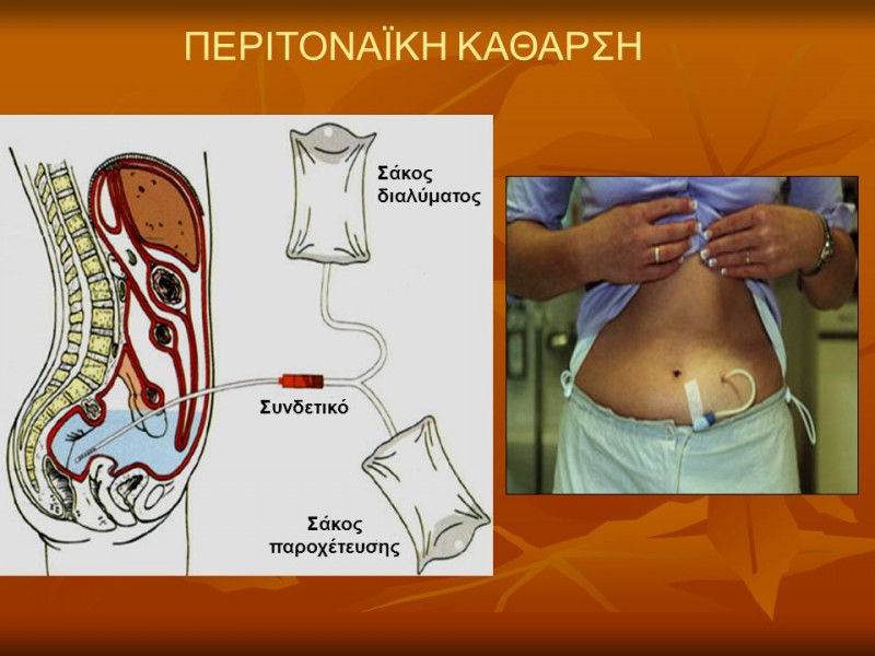 πως λειτουργεί η Περιτοναϊκή Κάθαρση